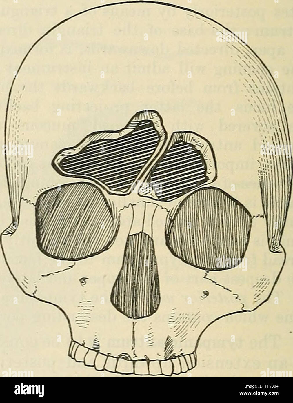 . Cunningham's Text-book of anatomy. Anatomy. Fig. 1075.—Frontal Sinuses of Average Dimensions, with a Medial Septum (Logan Turner). Fig. 1076. — A Large Right Frontal Sinus with Septum oblique to the Left (Logan Turner). form the mastoid cells, which radiate from the antrum, and either directly or indirectly communicate with it by small openings. In the pneumatic type of mastoid the whole of the process is excavated by these cells, which extend upwards into the squamous portion, forwards to the posterior wall of the osseous meatus (border-cells), and backwards into the occipital bone. Pus ret Stock Photo
