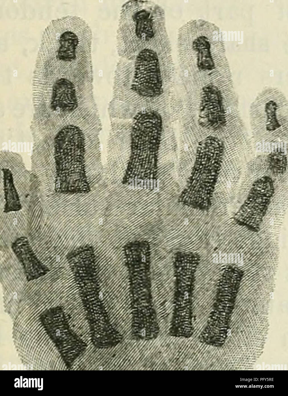 . Cunningham's Text-book of anatomy. Anatomy. THE METATAESUS. 265 tarsus determines the side-to-side roundness of the instep, whilst its plantar surface forms arches in both a transverse and longitudinal direction, in which the softer tissues of the sole are lodged, and so protected from injury. Ossification.—Unlike the carpus, the tarsus is at birth partially ossified. At this period there is a well-marked osseous nucleus within the body and neck of the talus, and the calcaneus is extensively ossified. In the latter the deposition of earthy matter appears as early as the sixth month of foetal Stock Photo