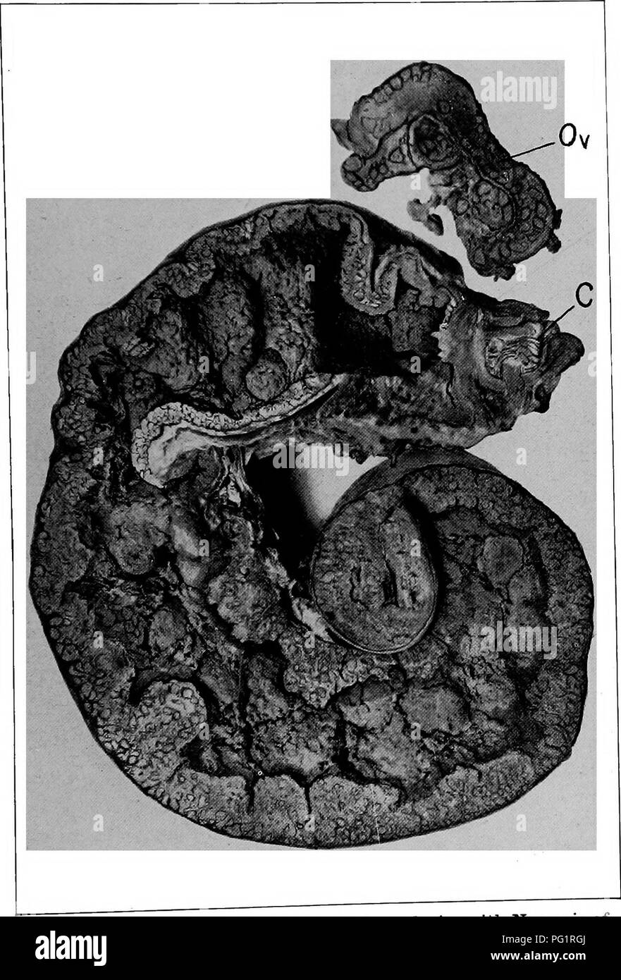 . The diseases of the genital organs of domestic animals. Veterinary medicine. Tubercidosis of the Female Genitalia 347. v,r loQ-Advanced Tubo-TJterme Tuberculosis, with Necrosis of ^ Mucosa and Pyometra. nz, Oviduct, greatly enlarged and consisting of a mass of tubercles ; ' C, cervical canal.. Please note that these images are extracted from scanned page images that may have been digitally enhanced for readability - coloration and appearance of these illustrations may not perfectly resemble the original work.. Williams, Walter Long, 1856-1945; Williams, Walter Wilkinson, 1892- joint author.  Stock Photo