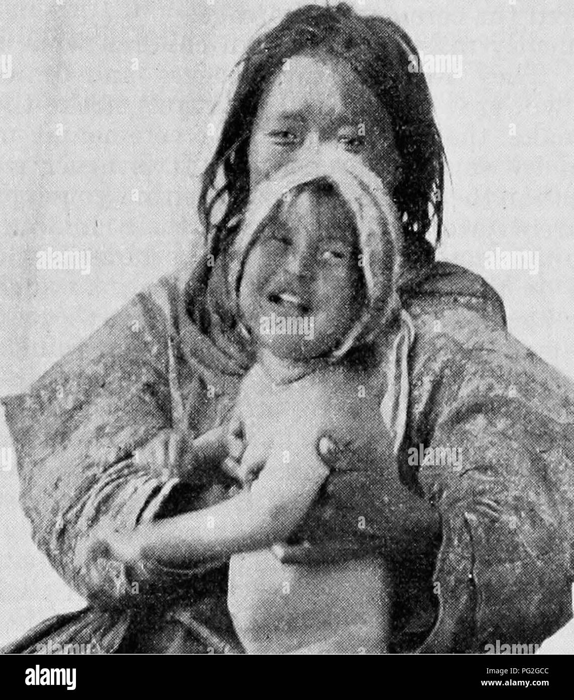 . Report of the Canadian Arctic Expedition 1913-18. Scientific expeditions. 166 Canadian Arctic Expedition, 1913-18 price of the adoption. After the baby was born, however, they decided to , keep all their children, and rather unscrupulously went back on the agreement without restoring either of the articles, the pot or the knife. Frequently the parents settle their problem by simply suffocating their baby and throwing it away. Even a mother will do this, for apparently she has no spontaneous affection for her offspring at the time that it is born. In the autumn of 1915 a Pingangnaktok native  Stock Photo
