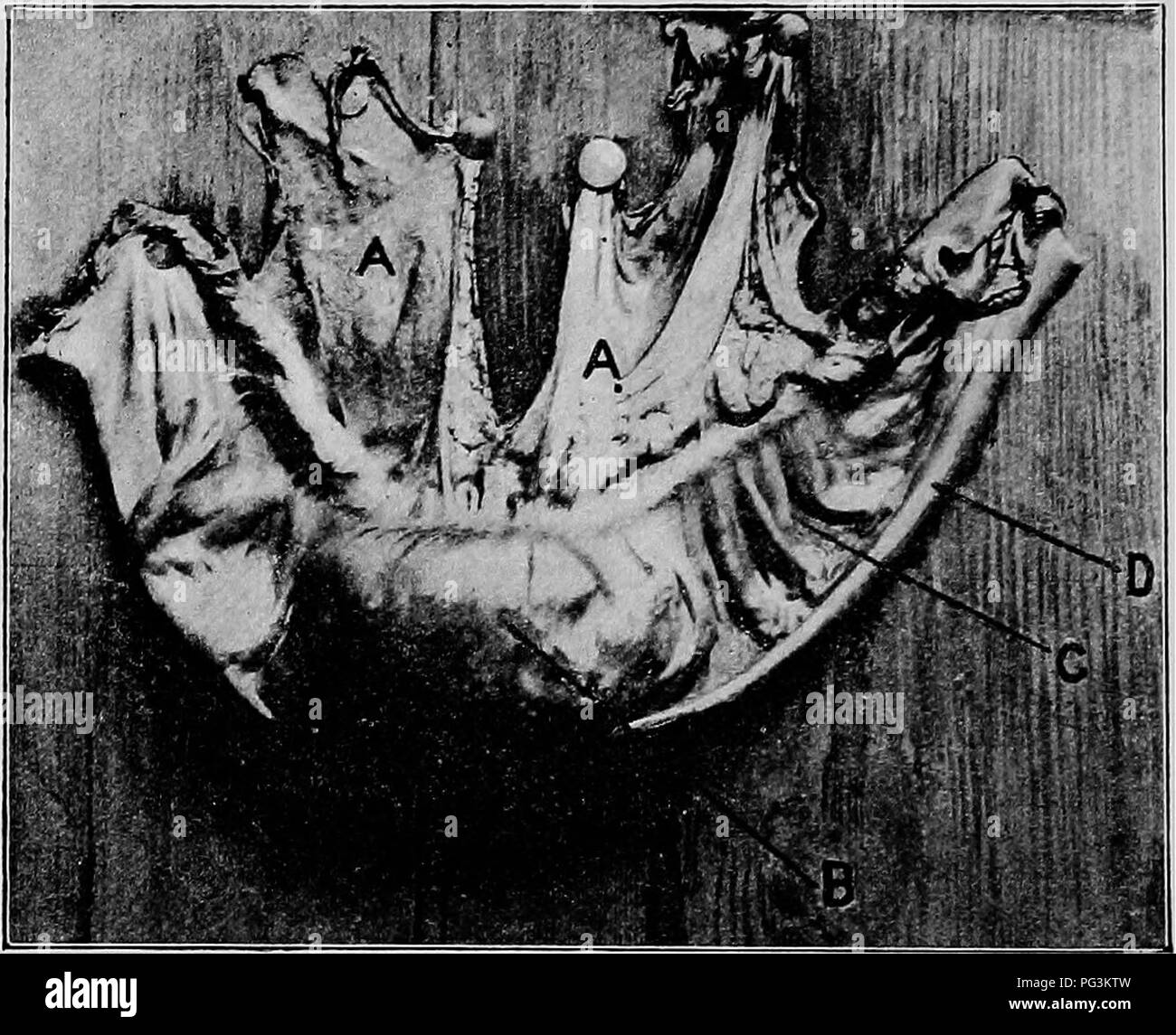 intestinal colic treatment