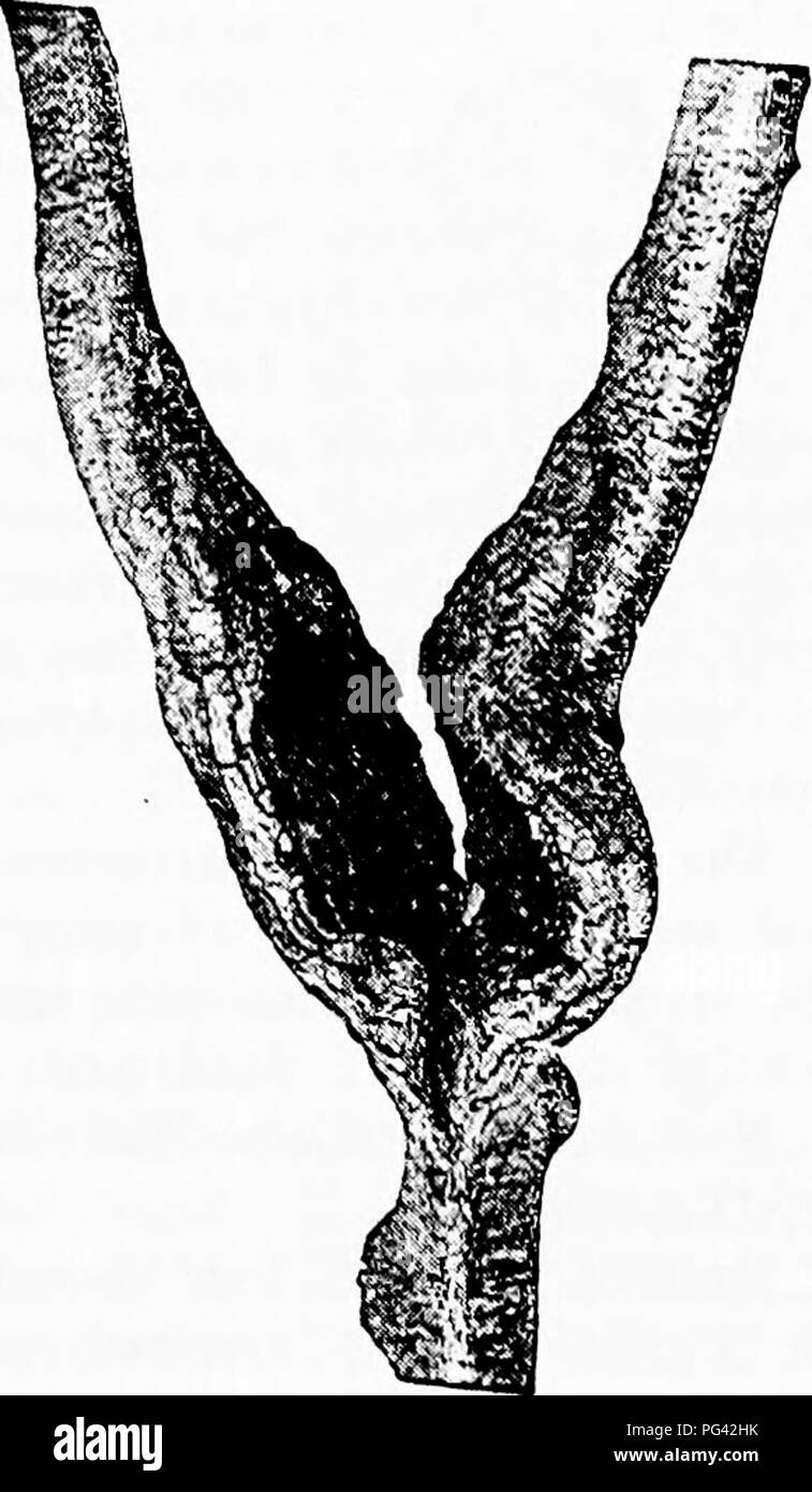 . Diseases of plants induced by cryptogamic parasites : introduction to the study of pathogenic Fungi, slime-Fungi, bacteria, &amp; Algae . Plant diseases; Parasitic plants; Fungi. Fig. so.—Nectfia ditissuna. Caukci- 011 a stem of Beech, (v. Tubeuf phot.) Fu;. SI.—Nectria ditissima. Canker on Hazel. The place of infection, a partially broken branch-fork. produced. The mycelium, at first gives off tiny unicellular conidia on the bark, then later white cushions bearing fine conidiophores, from which are abjointed multicellular conidia, shaped like a sickle. Infection is brought about by the germ Stock Photo