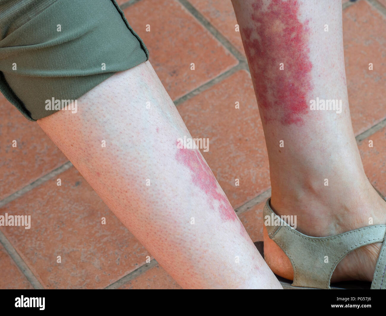 Leukocytoclastic vasculitis, an inflammatory reaction in the blood vessels. Aka golfer's, hiker's or exercise-induced-vasculitis or Disney rash. Stock Photo