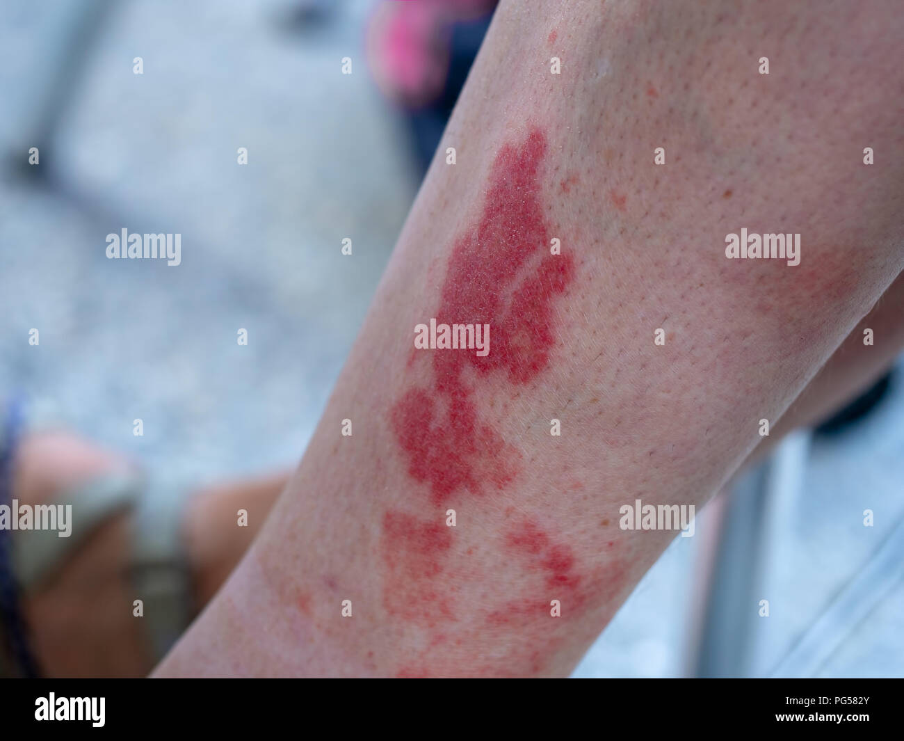 Leukocytoclastic vasculitis, an inflammatory reaction in the blood vessels. Aka golfer's, hiker's or exercise-induced-vasculitis or Disney rash. Stock Photo
