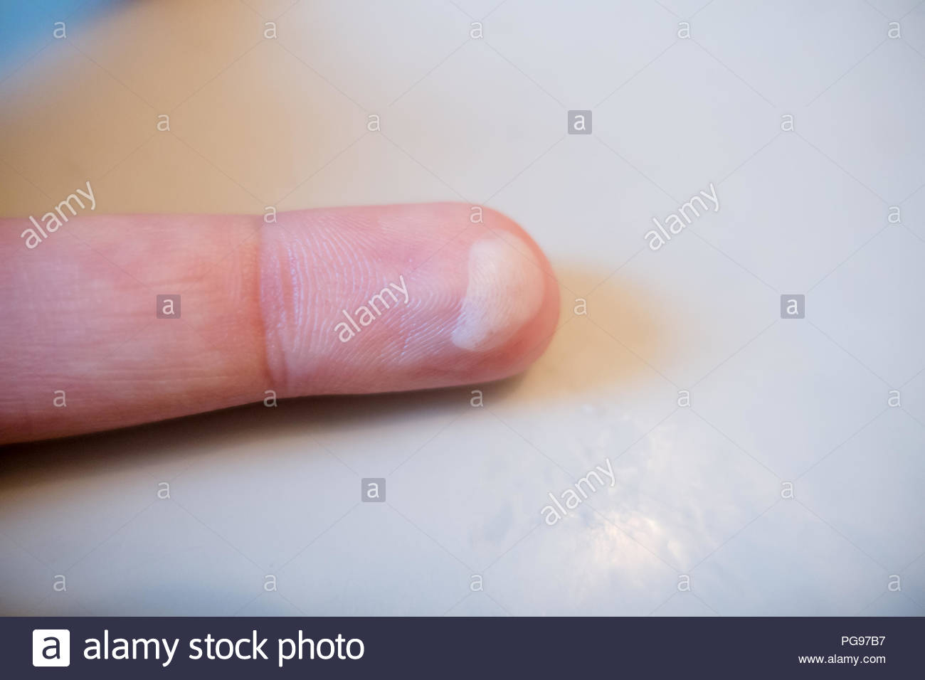 Burn Blister Stock Photos & Burn Blister Stock Images Alamy
