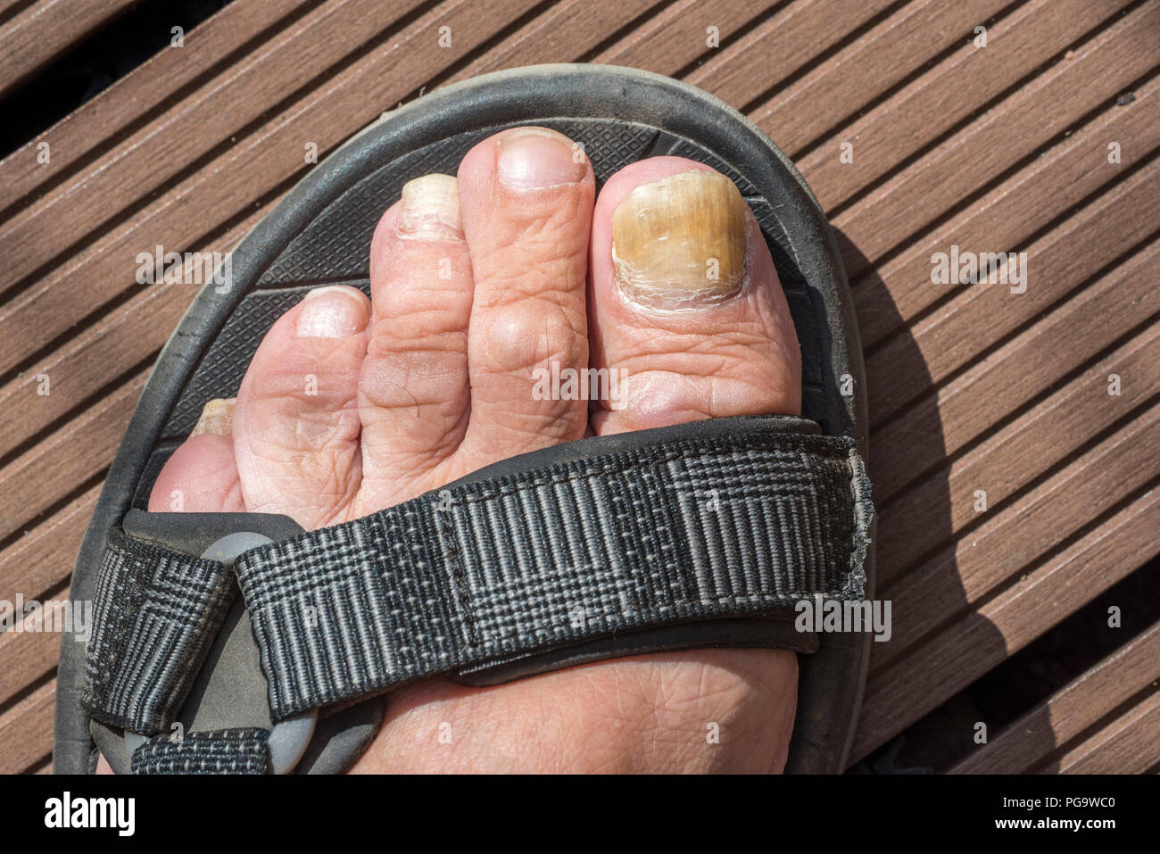 Foot in sandal showing Onychomycosis / tinea unguium, fungal infection of toenail / toe nail Stock Photo