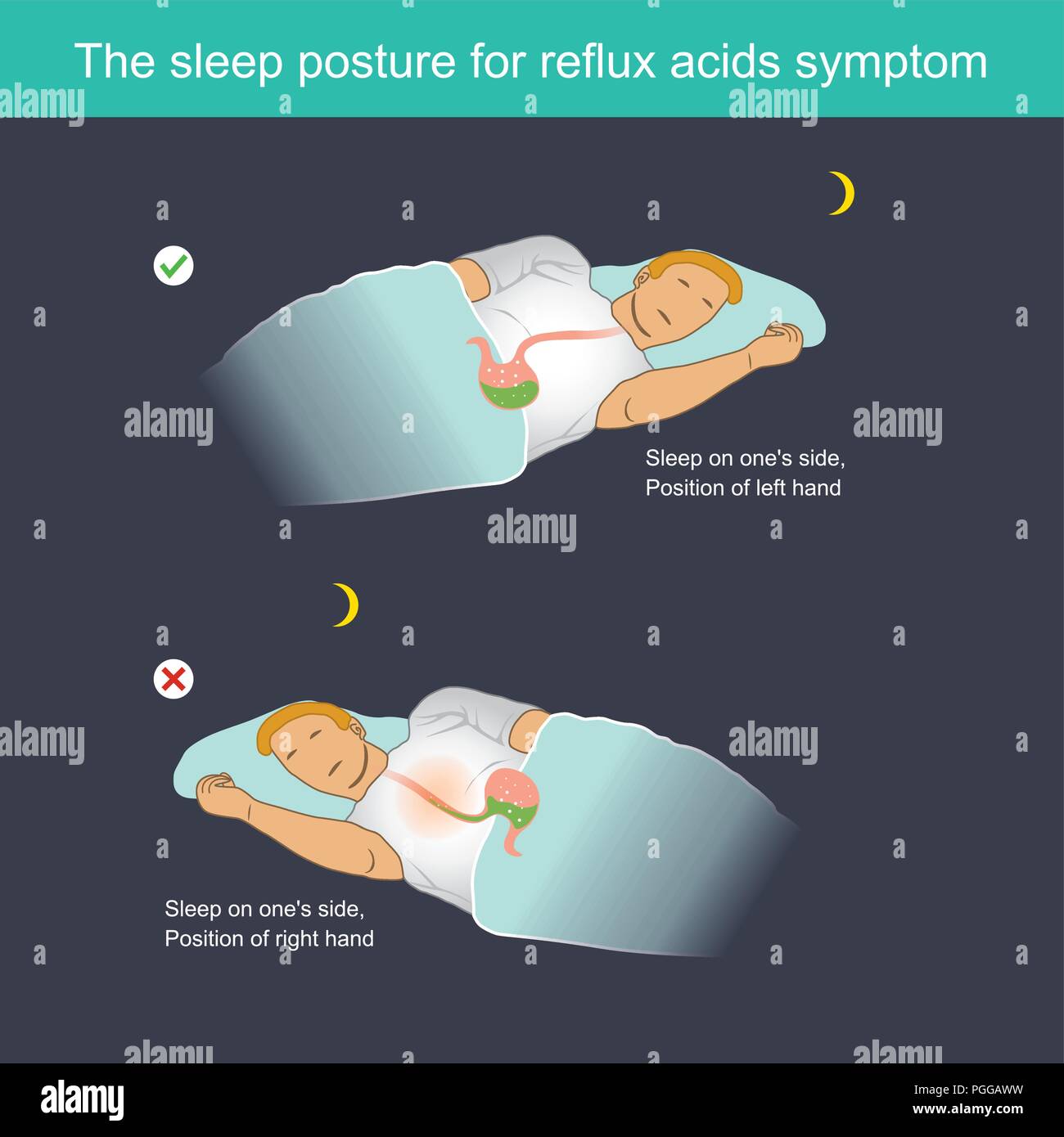 When sleeping, Stomach acid can flow back to the oesophagus, causing a