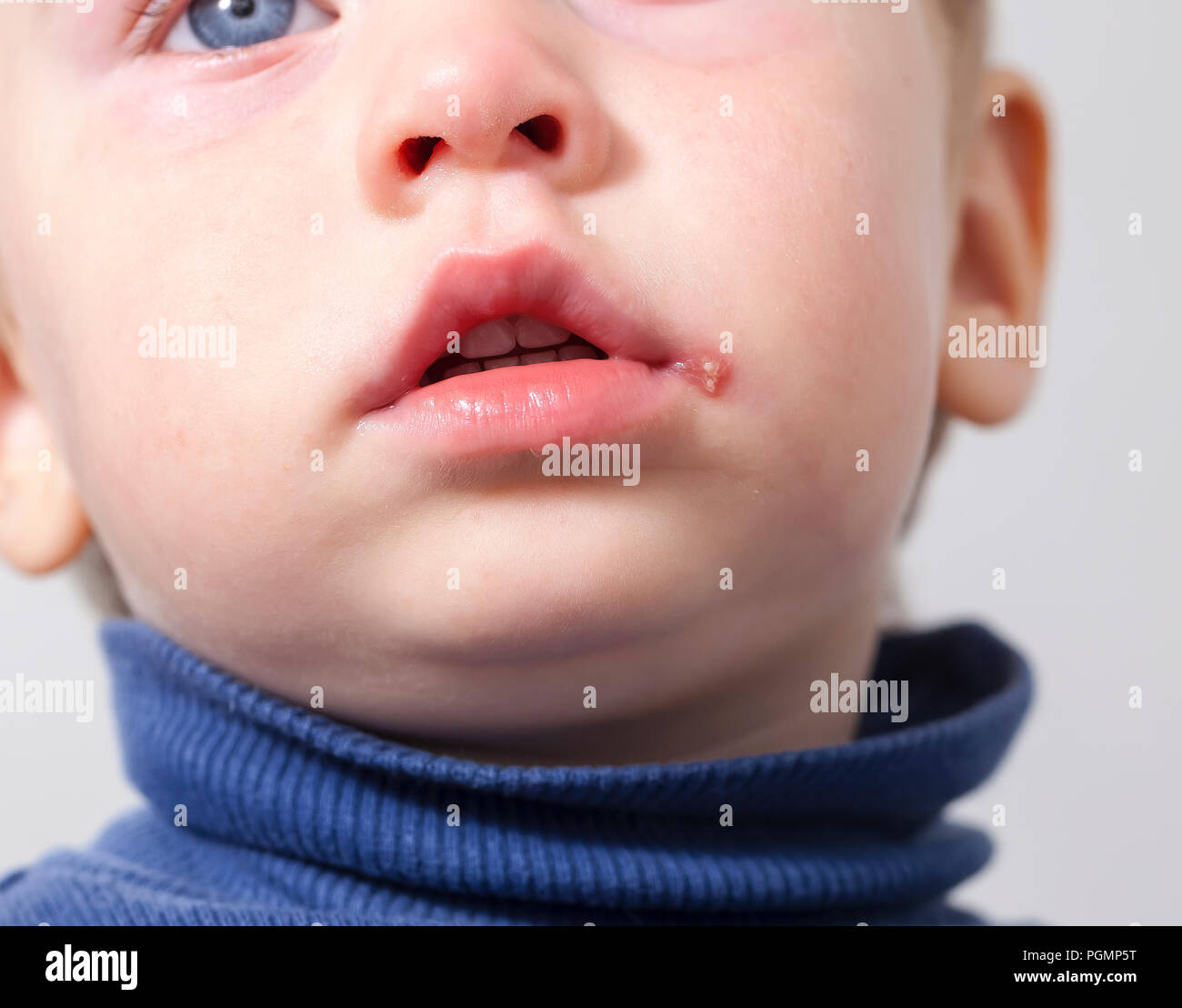 sore on the lip of the child . herpes Stock Photo