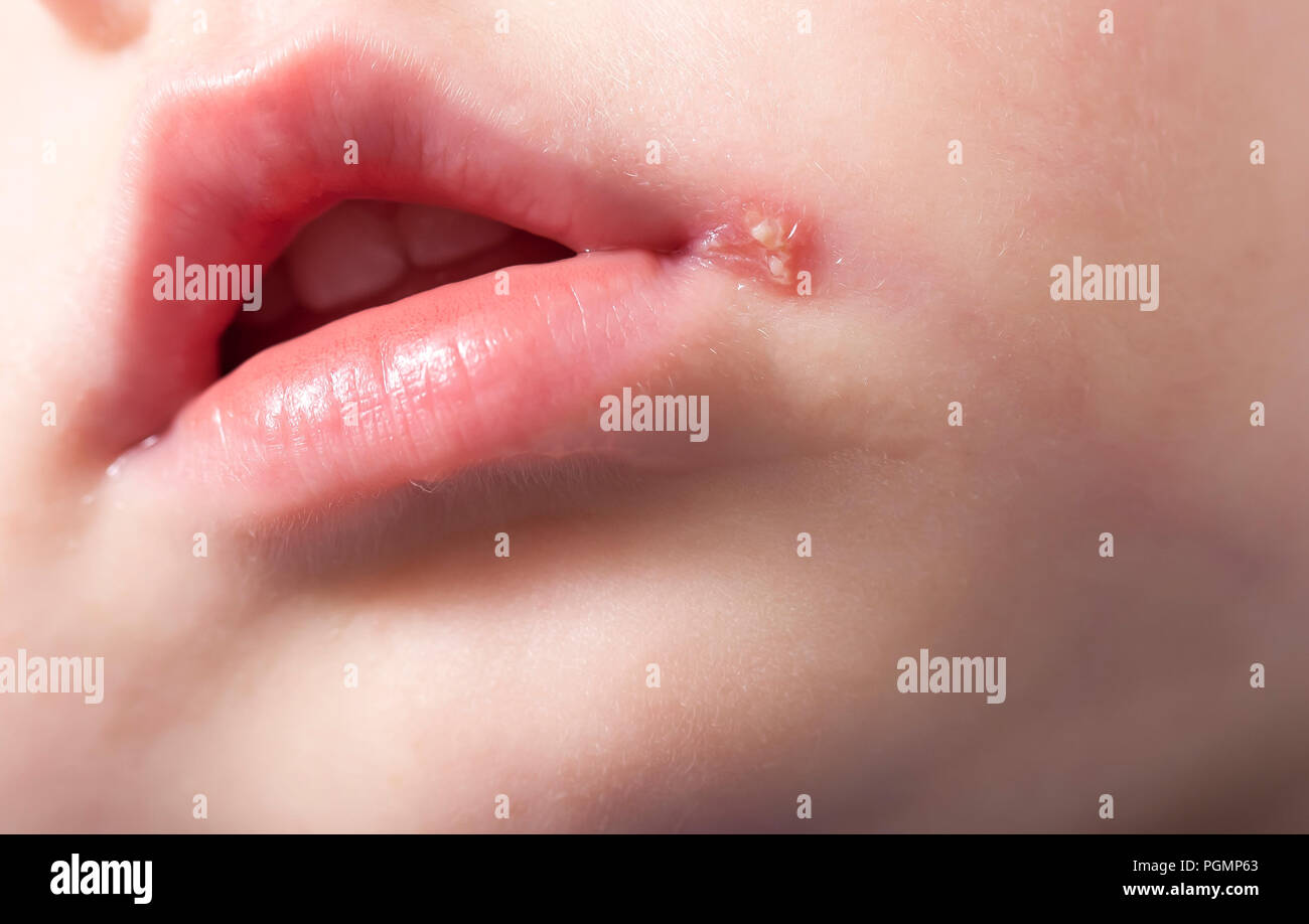 sore on the lip of the child . herpes Stock Photo