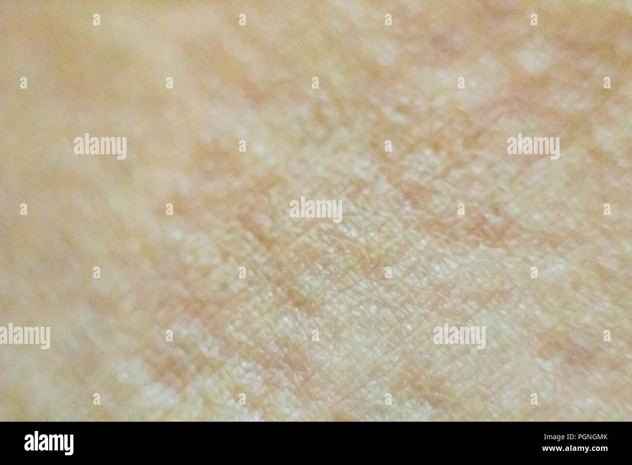 Close up view of cold urticaria allergic rash. Symptoms of itchy