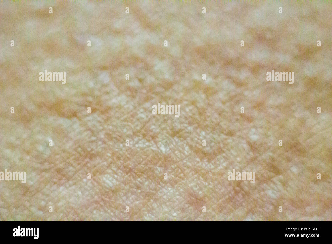 Close up view of cold urticaria allergic rash. Symptoms of itchy