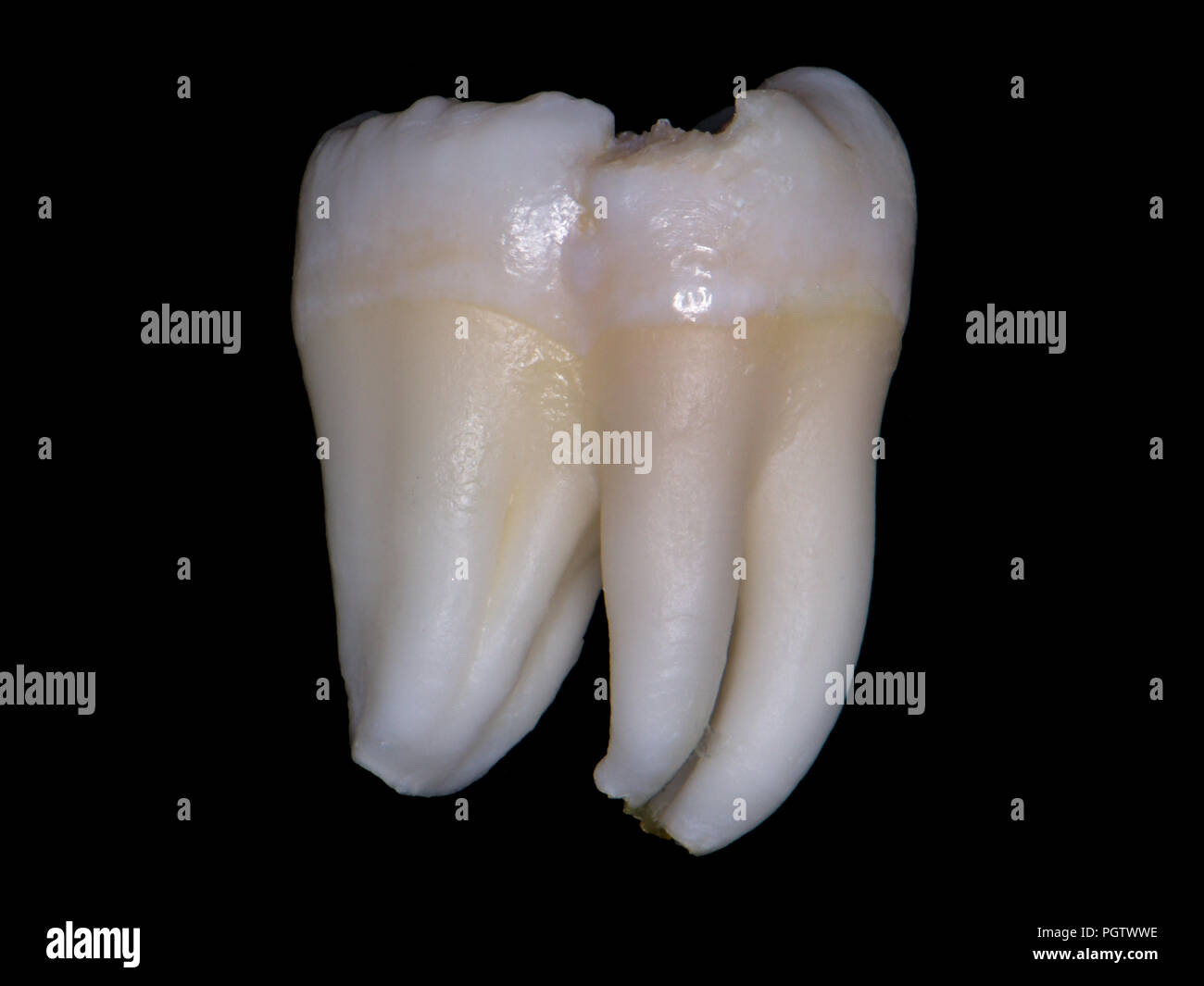 wisdom tooth, lower left molar, extra large, two tooth in one, fusion gemination or concrescentio? Stock Photo