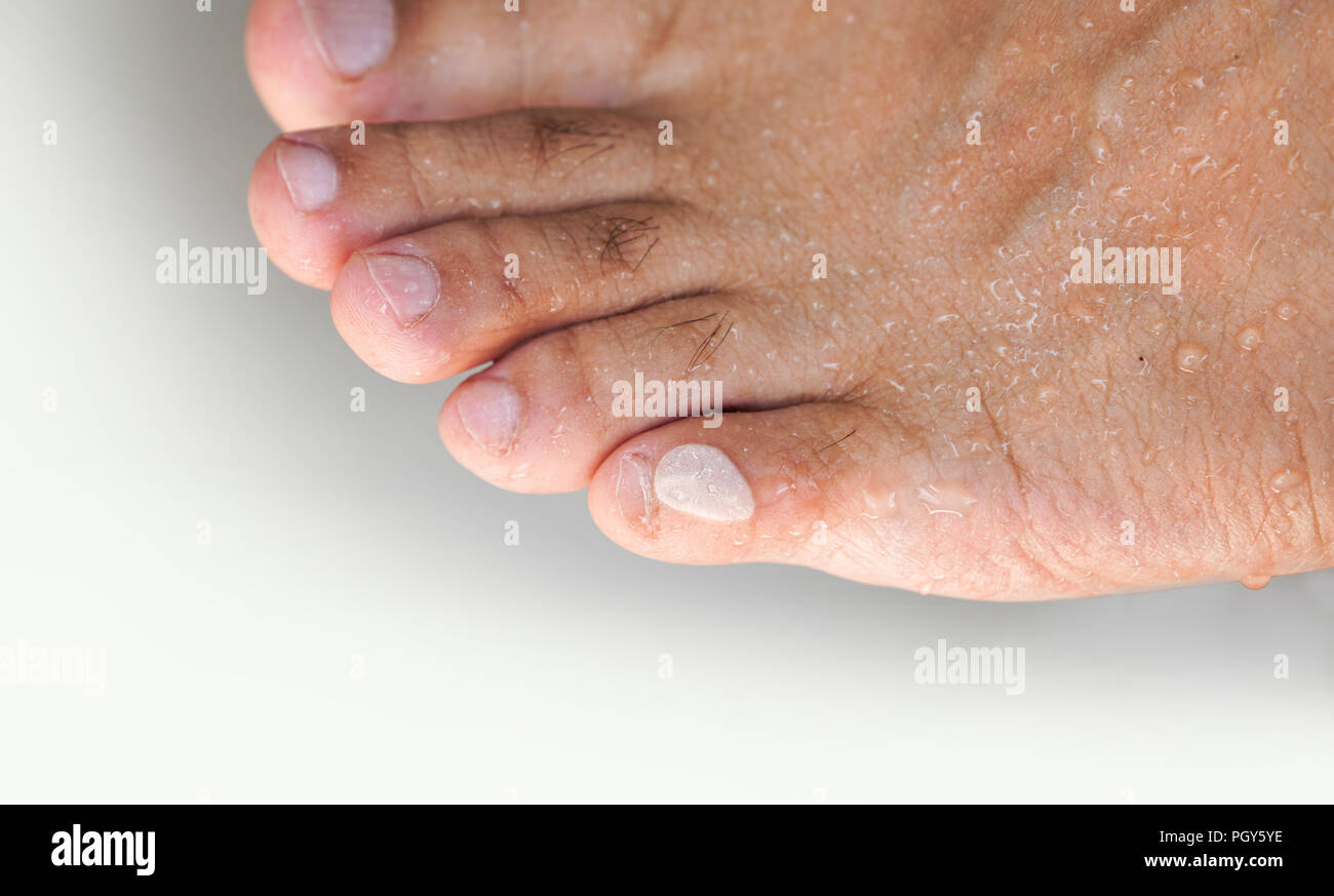 Swollen toes hires stock photography and images Alamy
