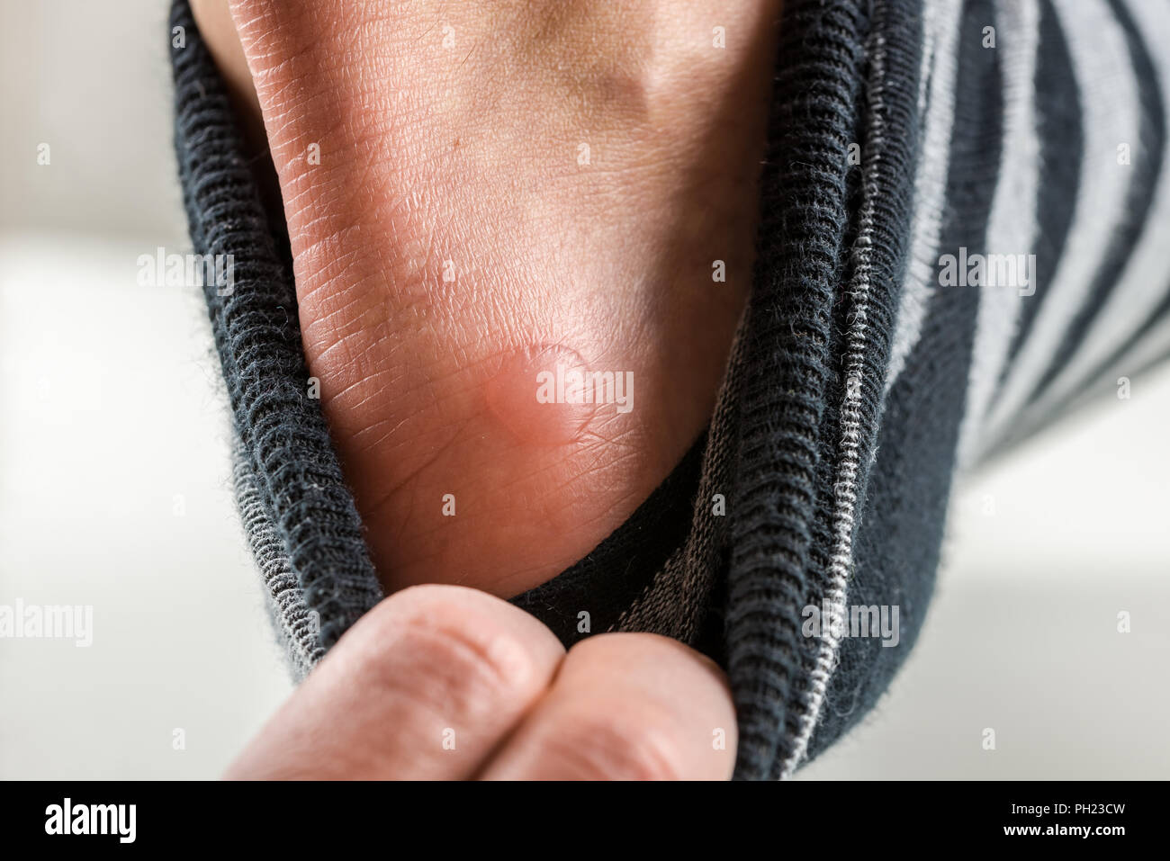 Friction blister hires stock photography and images Alamy