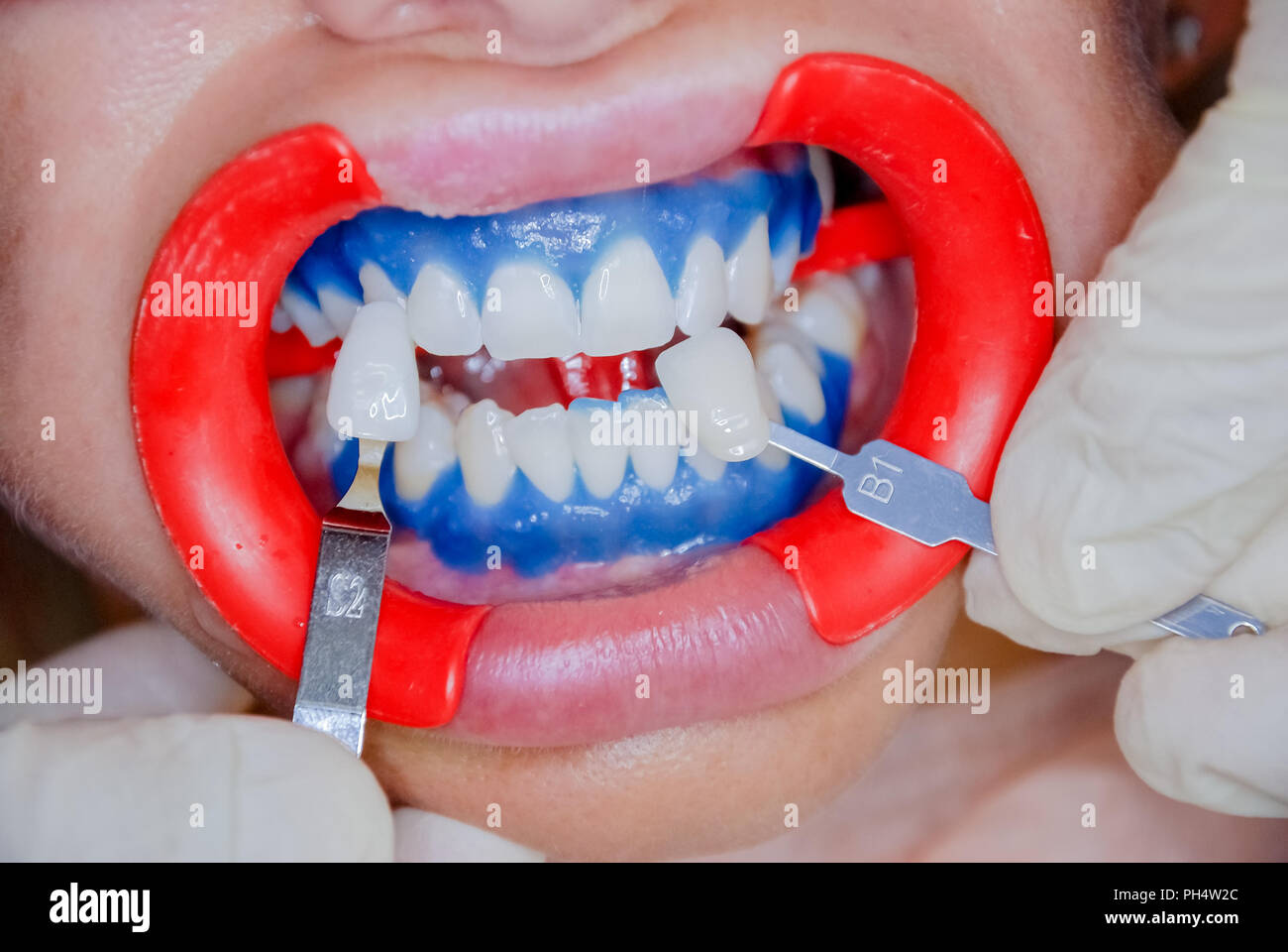Dentist finishing teeth whitening procedure with young woman. see a result.Dentist holding tooth color chart.dentist office Teeth care and tooth health concept Stock Photo