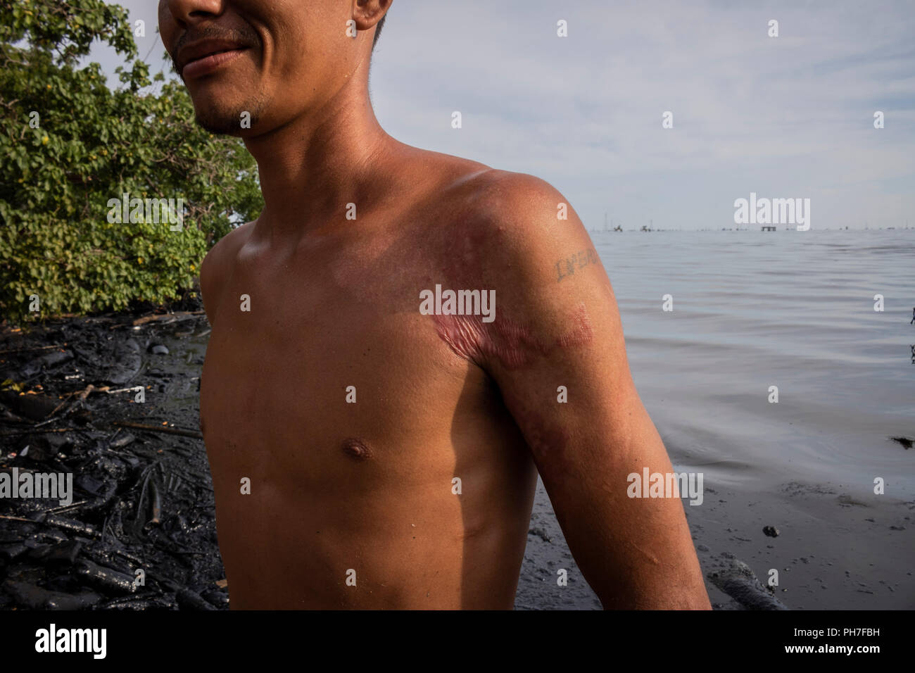 17 August 2018, Venezuela, Maracaibo: A man stands on the shore of Lake Maracaibo, polluted with oil, showing scars on his skin. He works as a fisherman. Parts of his body have been exposed to oil for long periods of time. It is said to have inflicted his wounds. Underneath the lake are large deposits from which the state-owned Venezuelan company PDVSA produces oil and gas. Oil pipelines are already leaking there. However, the pollution of the lake seems to have become chronic. There are hardly any official figures on this, given the situation, which is strictly controlled by the national regi Stock Photo