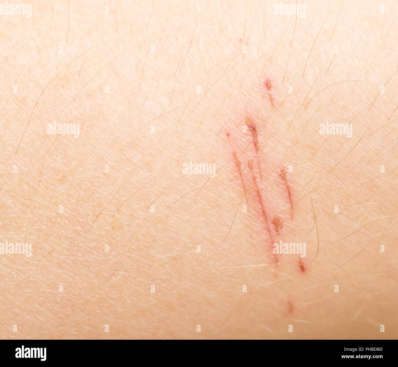 Dog nail scratch on human sales