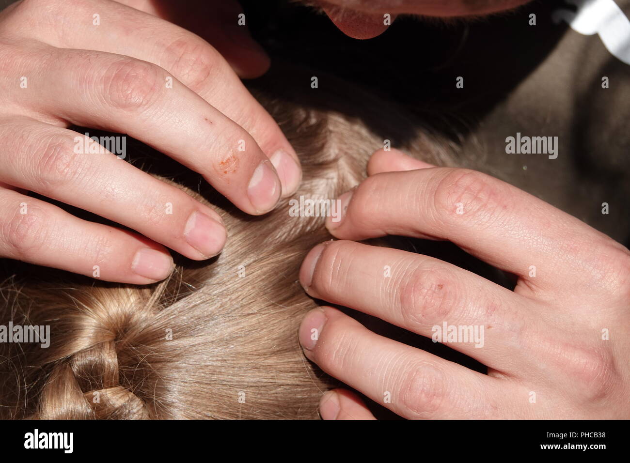 Head Lice Infection Common In Young People Hair Being Checked