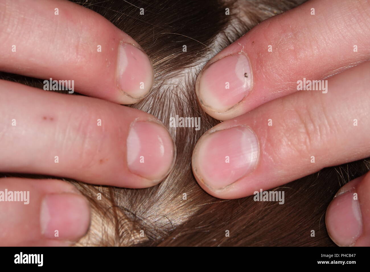 Head Lice Child Stock Photos Head Lice Child Stock Images Alamy