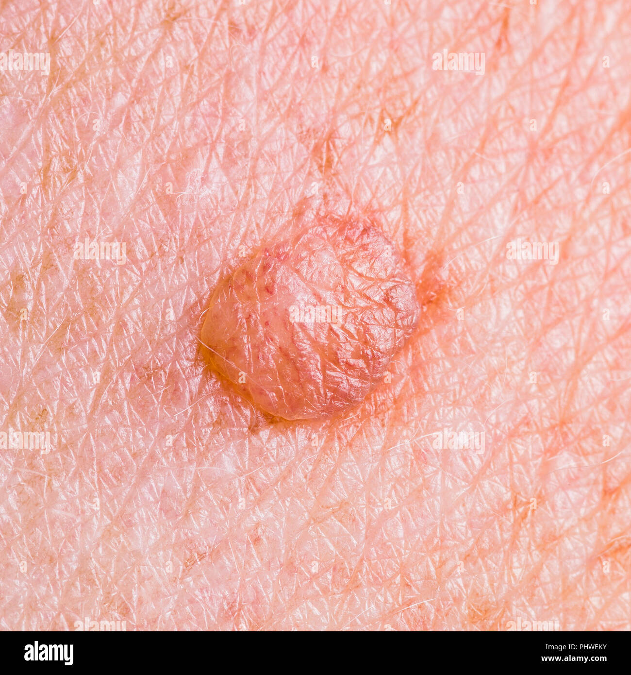 Skin Mole Defect High Magnification Macro Photo for Medical Diagnosis Stock Photo