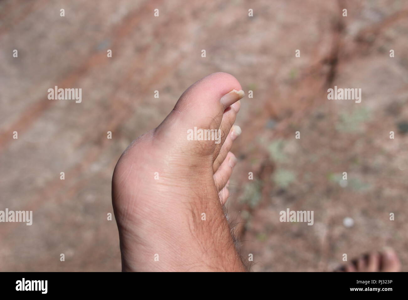 Closeup of a human foot and toes with cracked and peeling toe nails