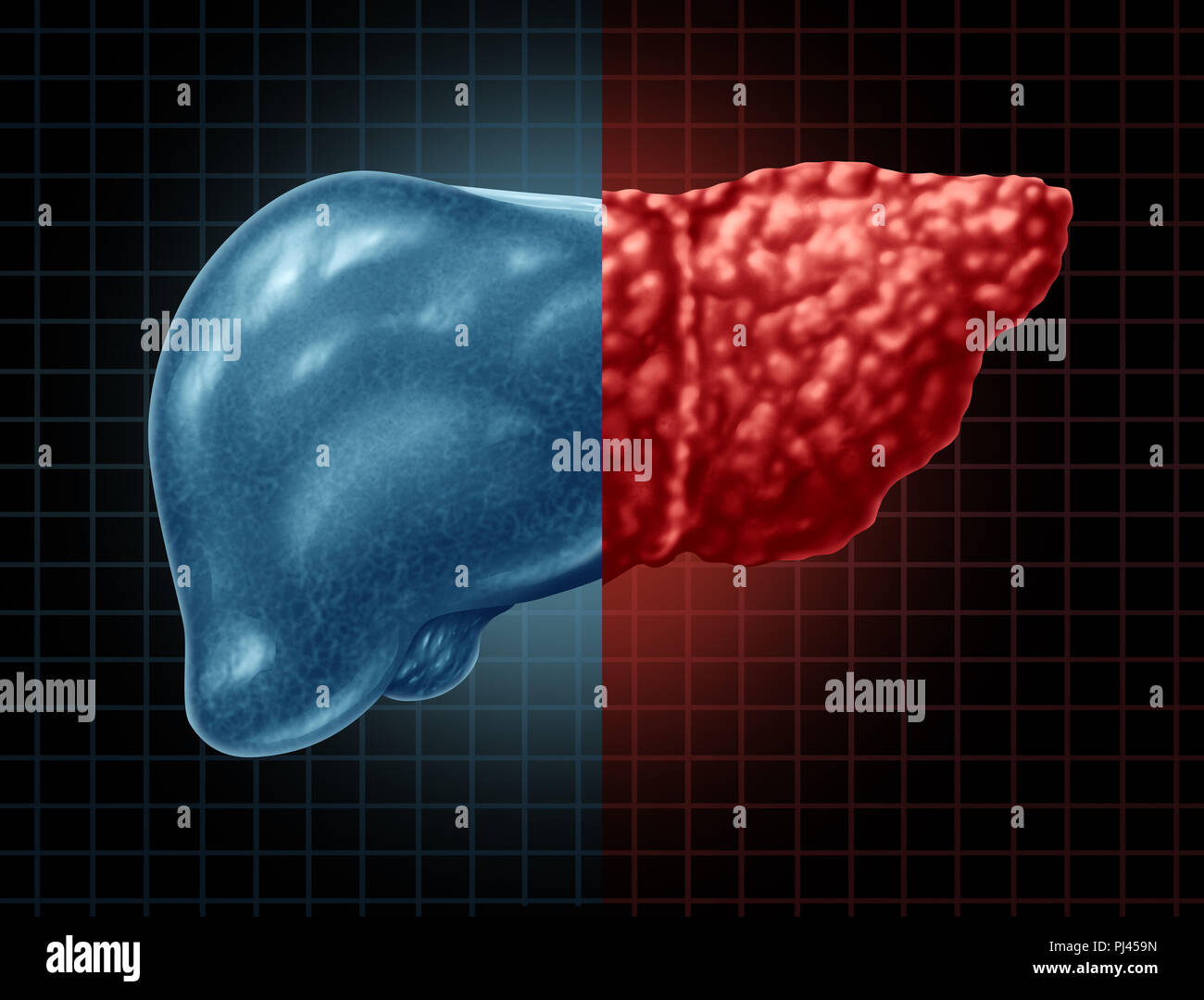 Fatty liver hi-res stock photography and images - Alamy