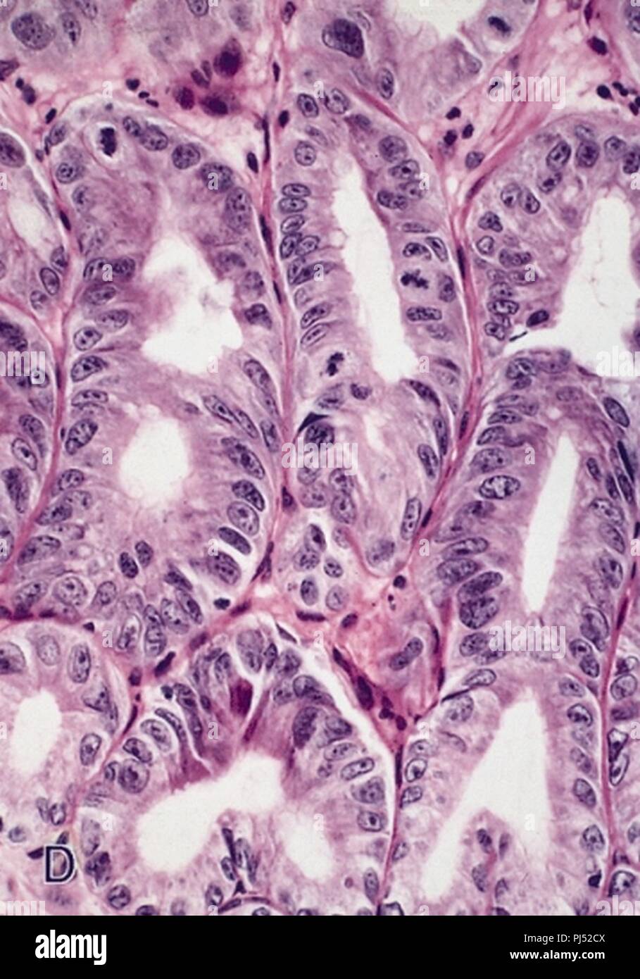 Barrett's mucosa lowgrade dysplasia H&E Stock Photo Alamy