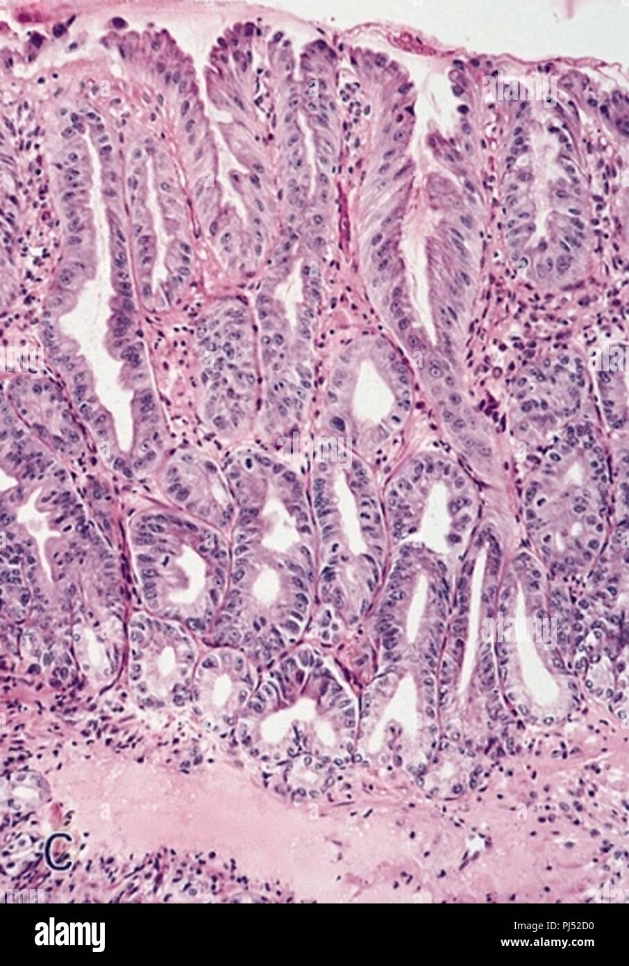 Barrett's mucosa lowgrade dysplasia lowpower view H&E Stock Photo Alamy