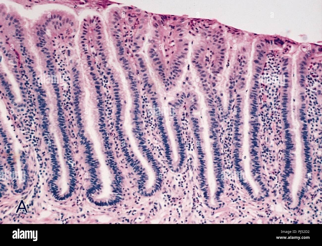 Barrett's mucosa lowgrade dysplasia Stock Photo Alamy