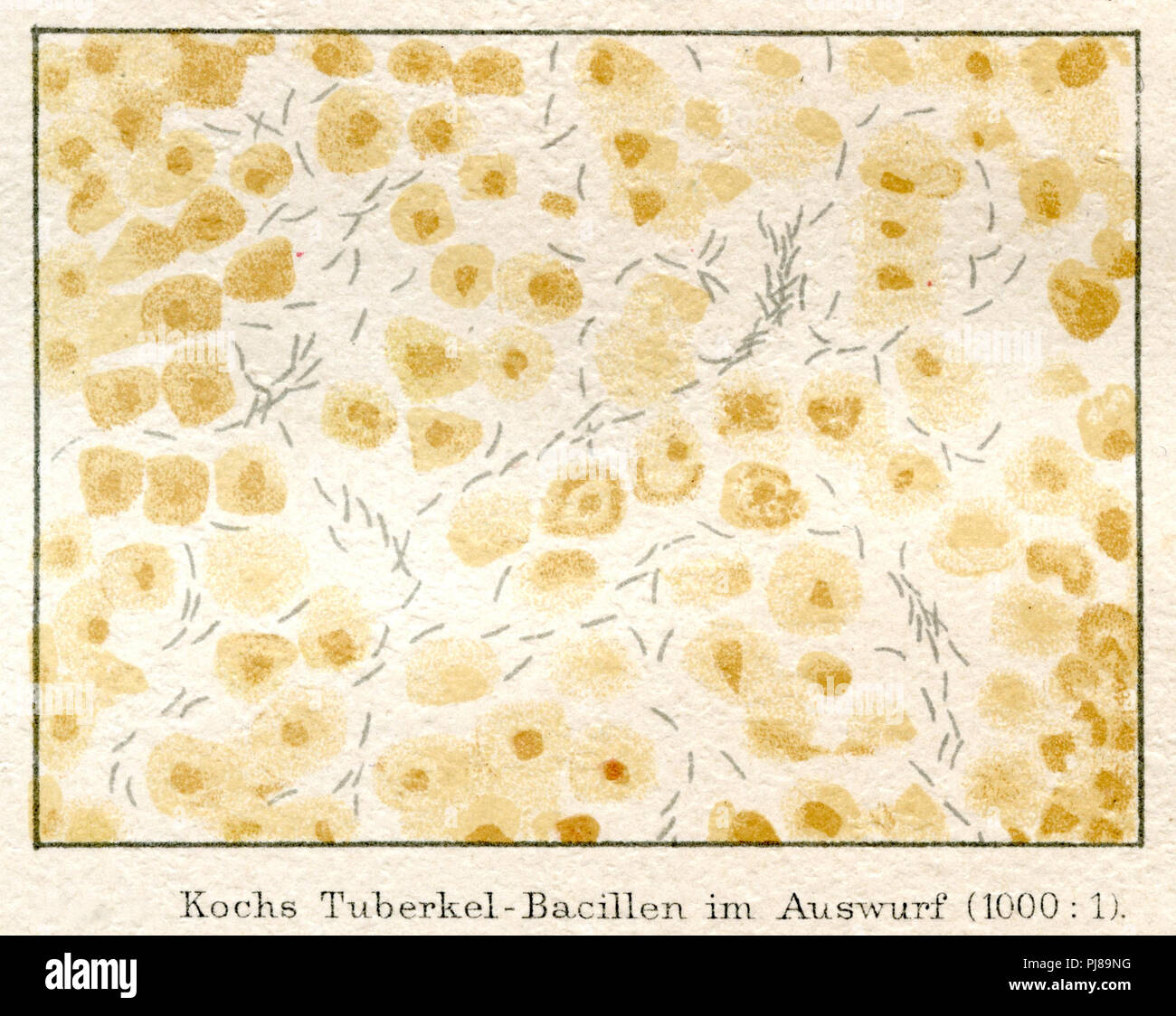 Koch's tubercle bacteria in the sputum of a patient under the microscope (1000: 1).,   1885 Stock Photo