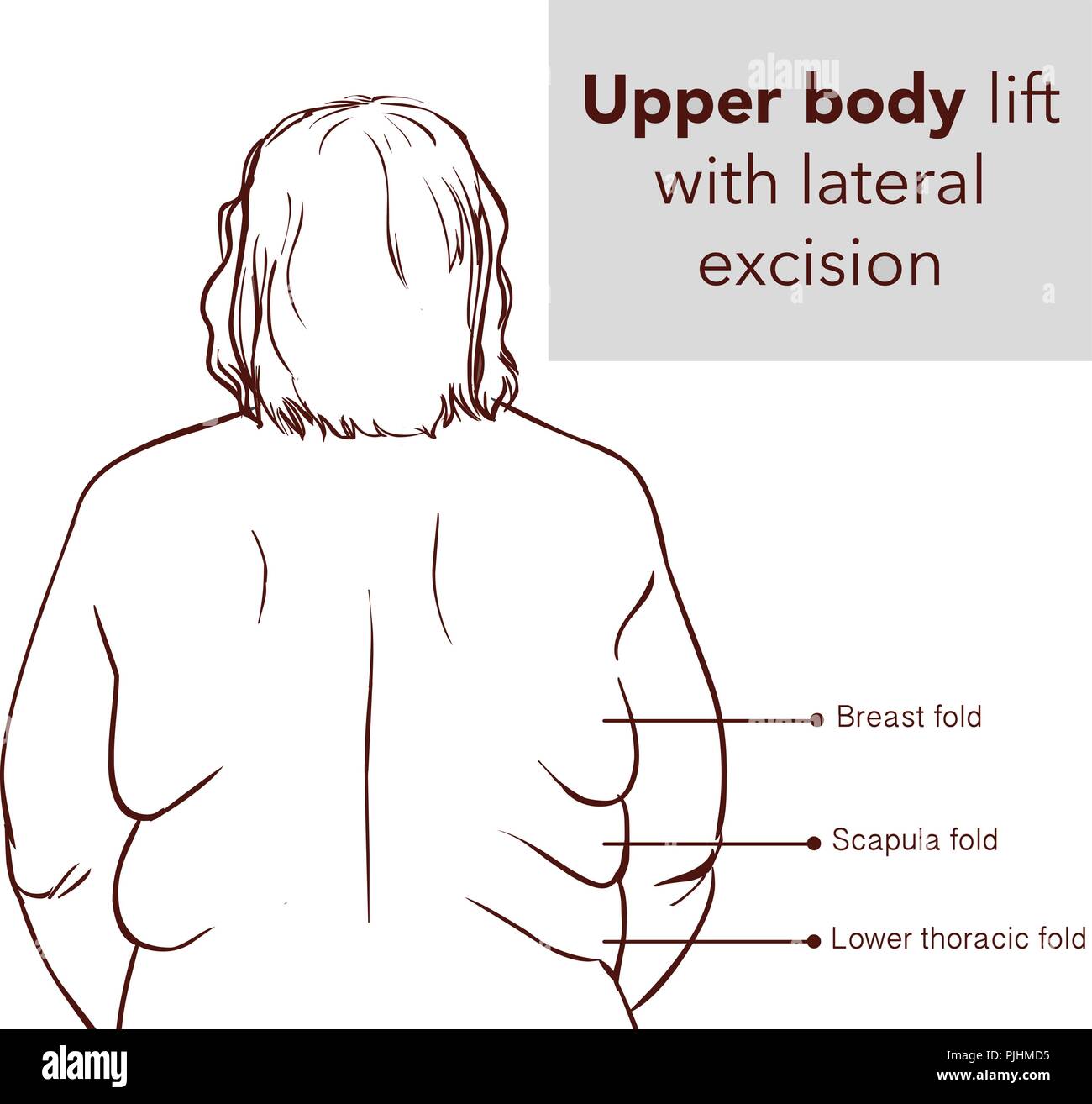 UPPER BODY LİFT WİTH LATERAL EXCİSİON2 Stock Vector Image & Art Alamy