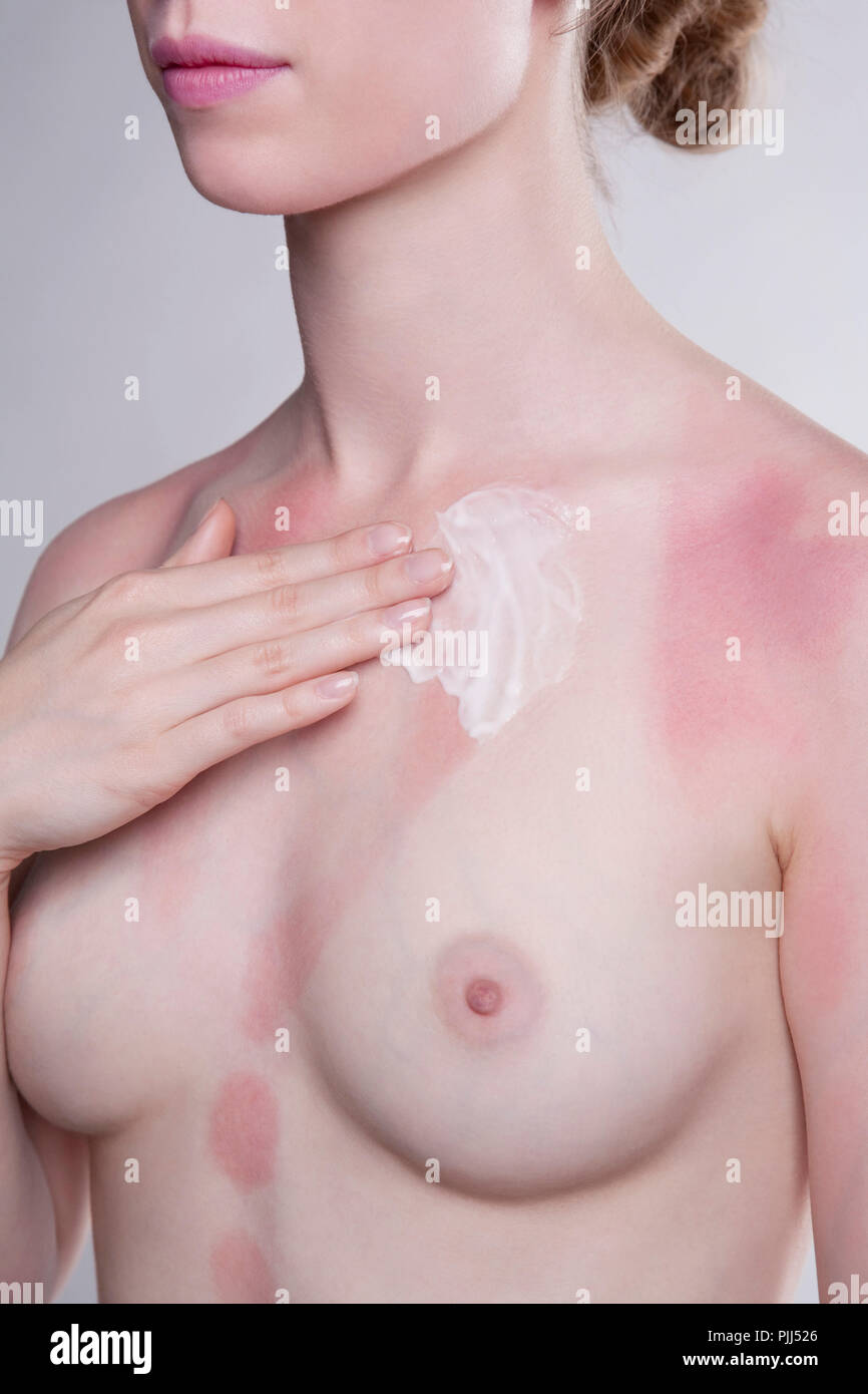 Woman breast with sunburn Stock Photo - Alamy