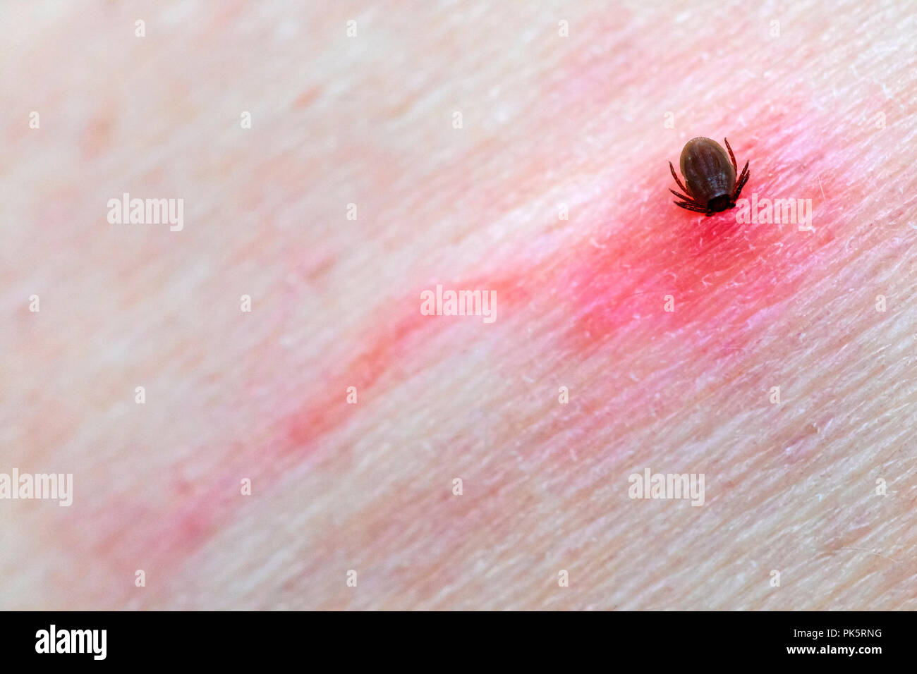 Tick Feeding on a Humans Skin With Inflamed Area Around Bite.  Such Ticks can cause Lyme Disease (Lyme Borreliosis) as well as Other Serious Diseases. Stock Photo
