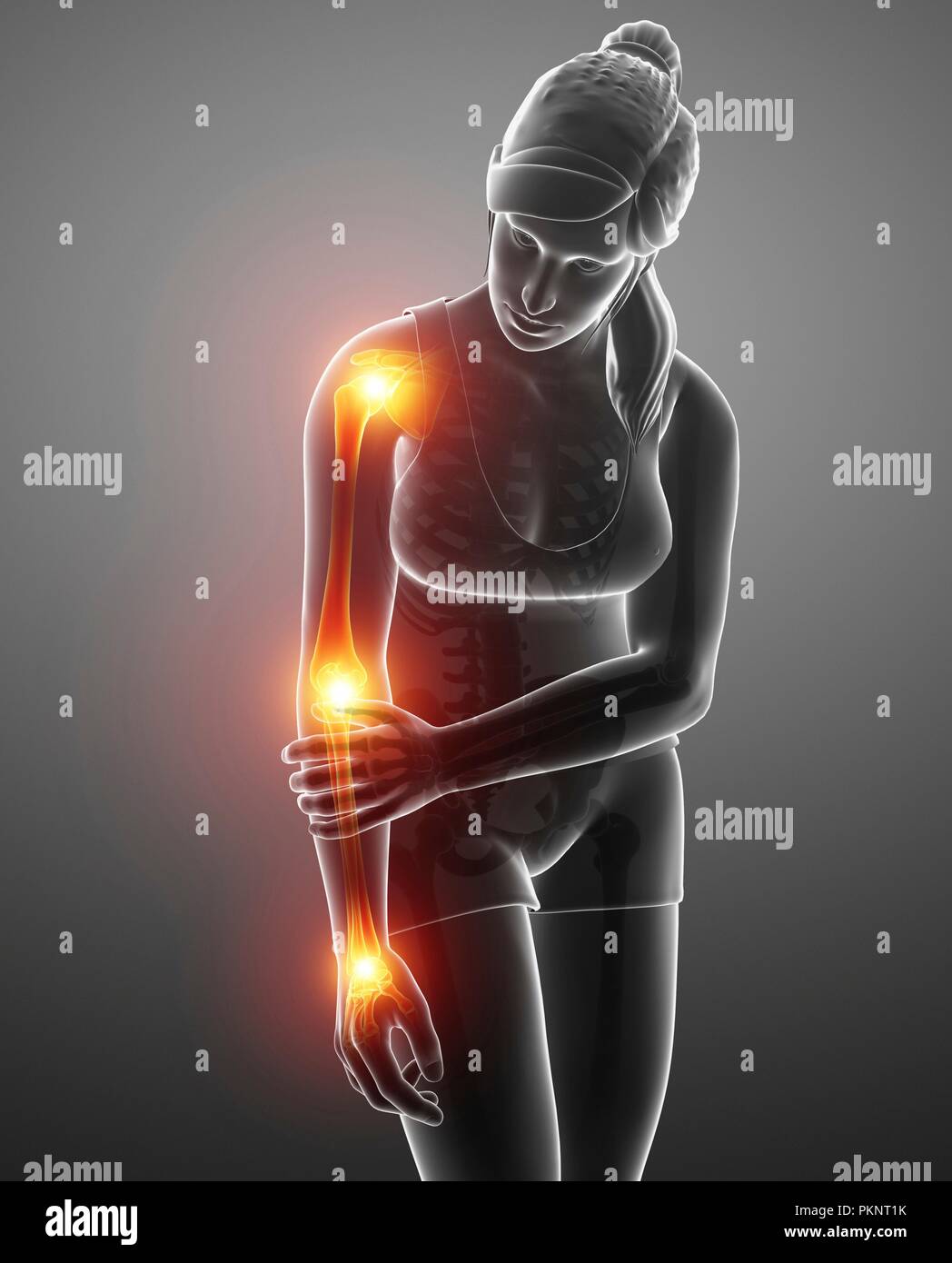 Woman with arm pain, computer illustration Stock Photo Alamy