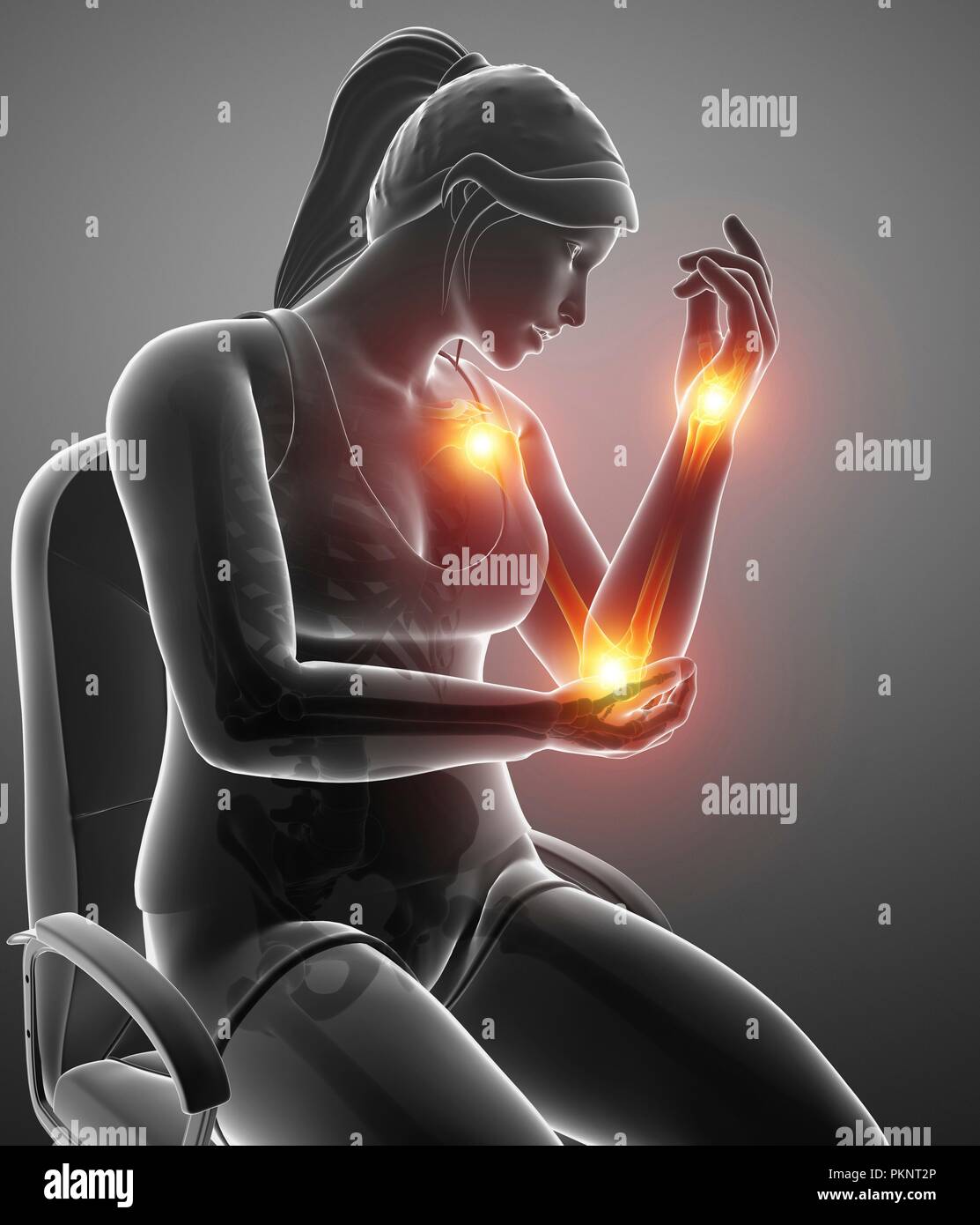 Woman with arm pain, computer illustration Stock Photo Alamy