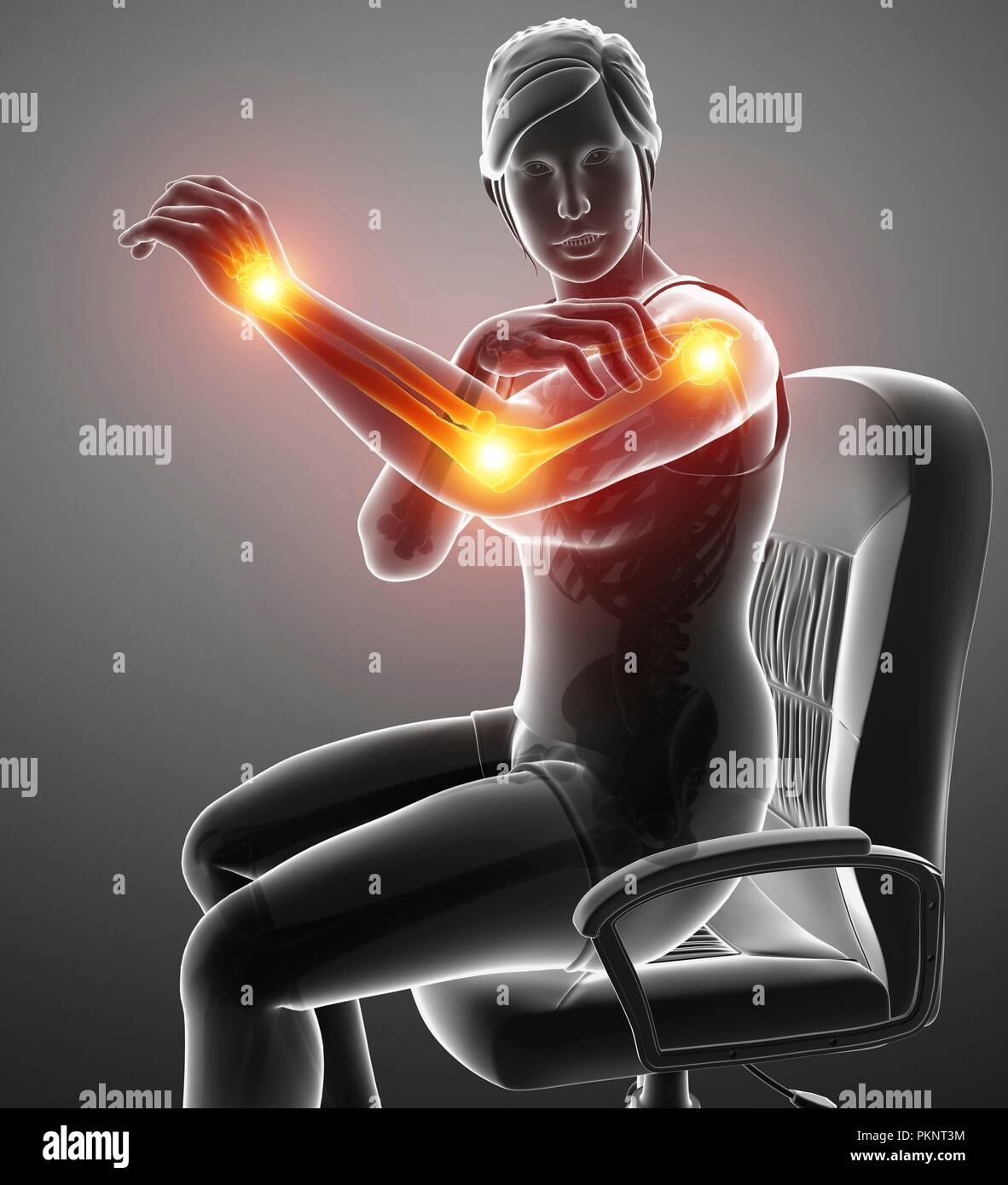 Woman with arm pain, computer illustration Stock Photo Alamy