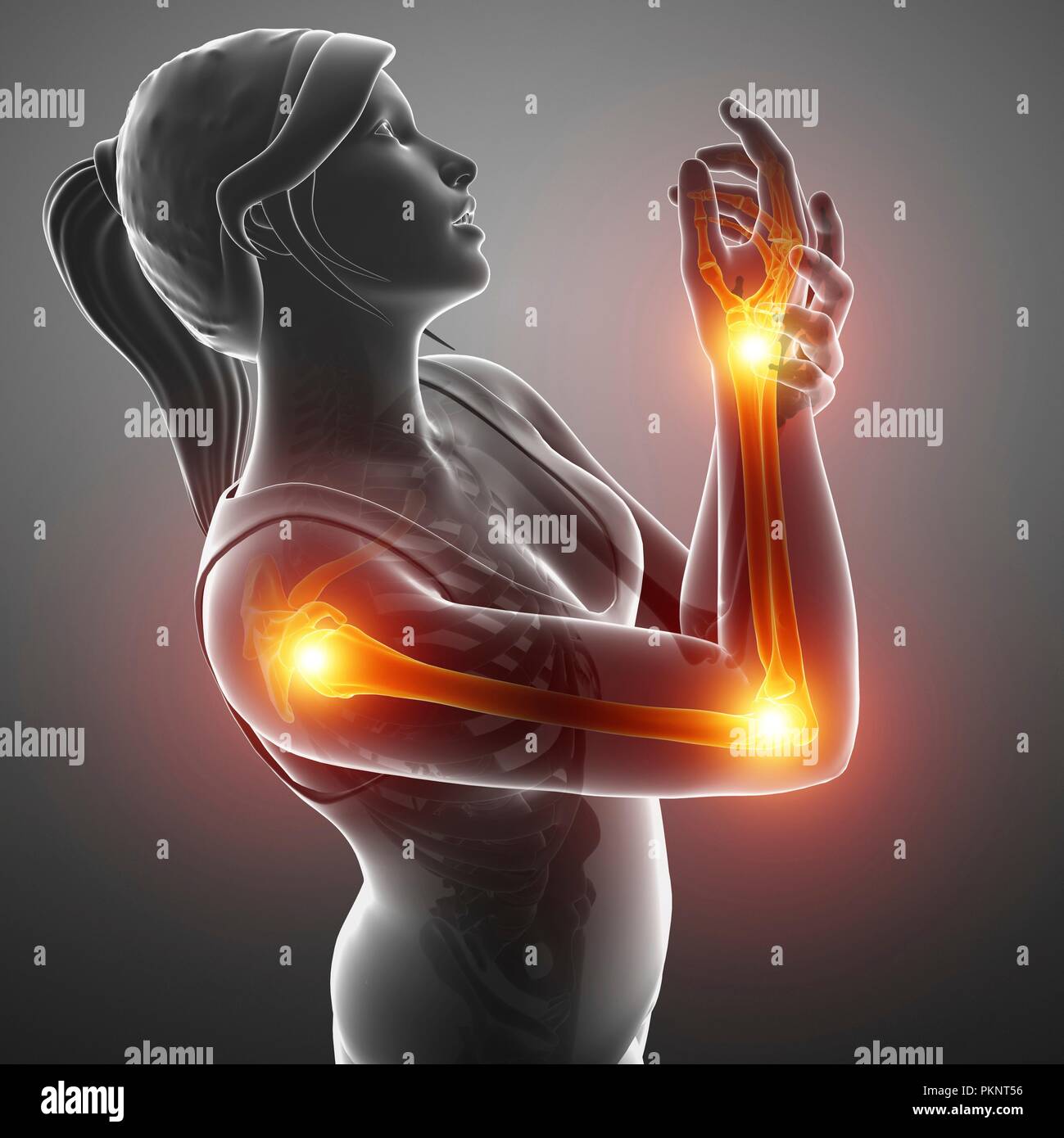 Woman with arm pain, computer illustration Stock Photo Alamy