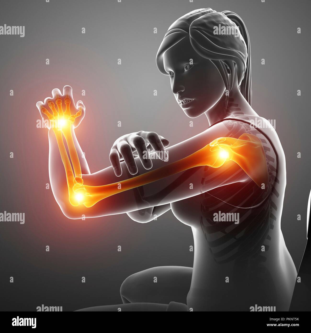 Woman with arm pain, computer illustration Stock Photo Alamy