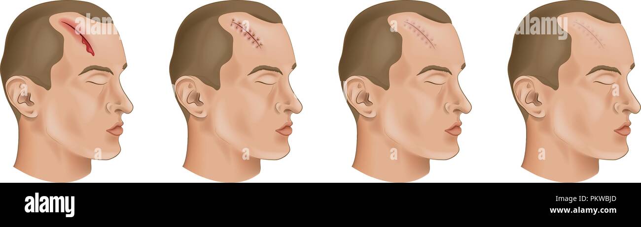 vector illustration of a cut head wound Stock Vector