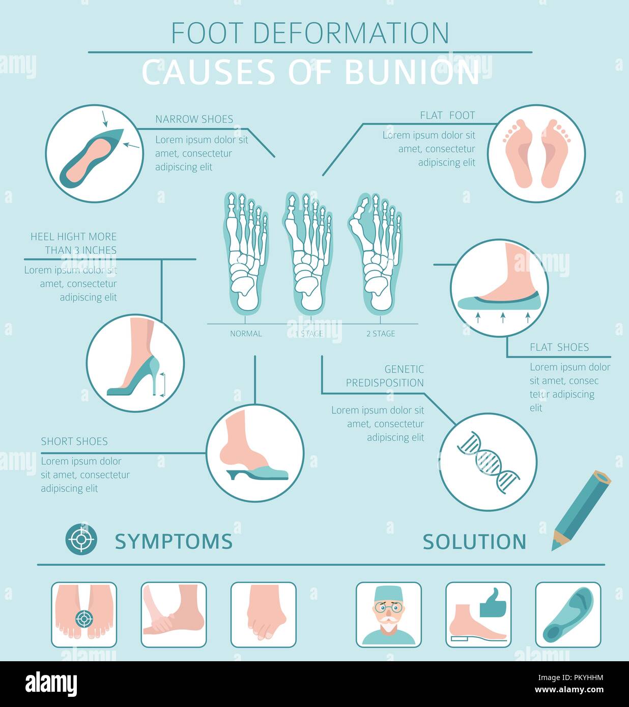 Foot deformation as medical desease infographic. Causes of bunion. Vector illustration Stock Vector