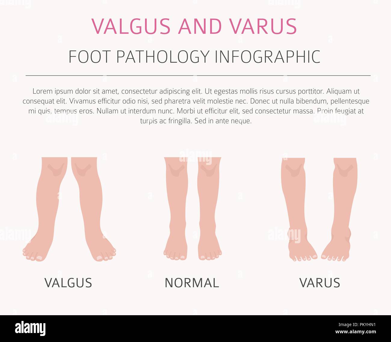 Foot deformation as medical desease infographic. Valgus and varus defect. Vector illustration Stock Vector