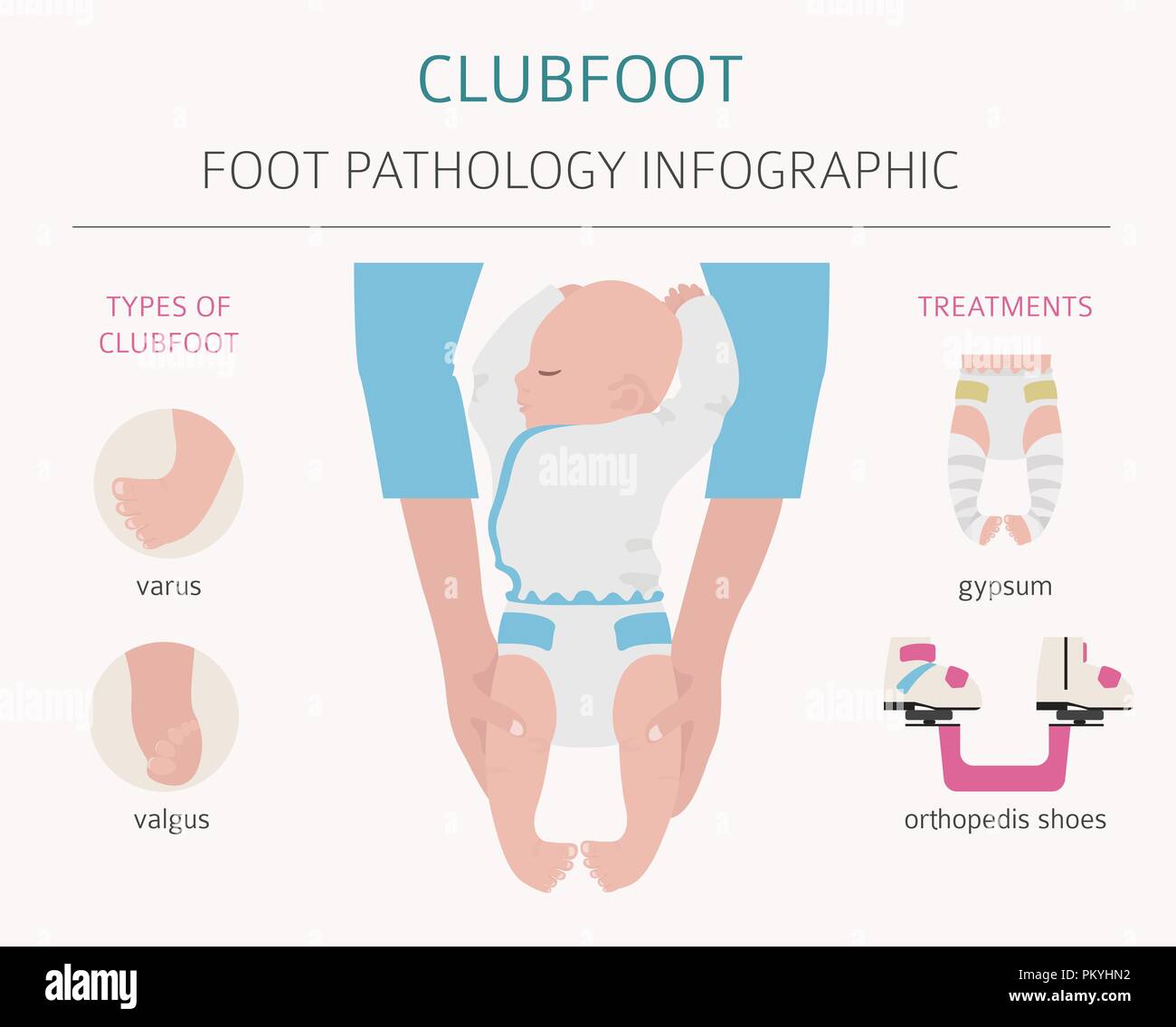 Foot Deformation Medical Desease Infographic Clubfoot Defect Vector Illustration Stock Vector Image Art Alamy