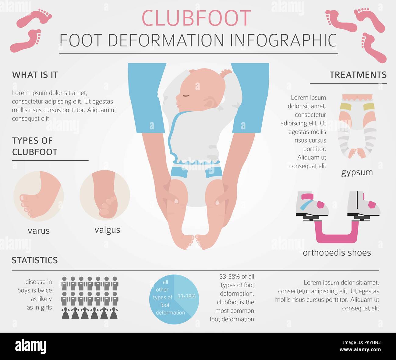 Foot Deformation Medical Desease Infographic Clubfoot Defect Vector Illustration Stock Vector Image Art Alamy