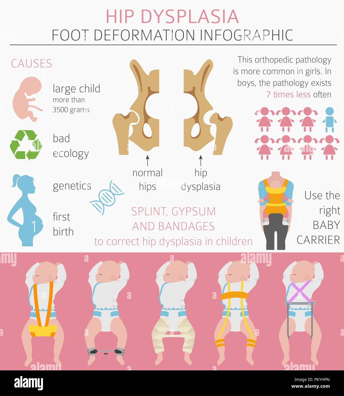 Types Of Hip Dysplasia At Christopher Schauer Blog