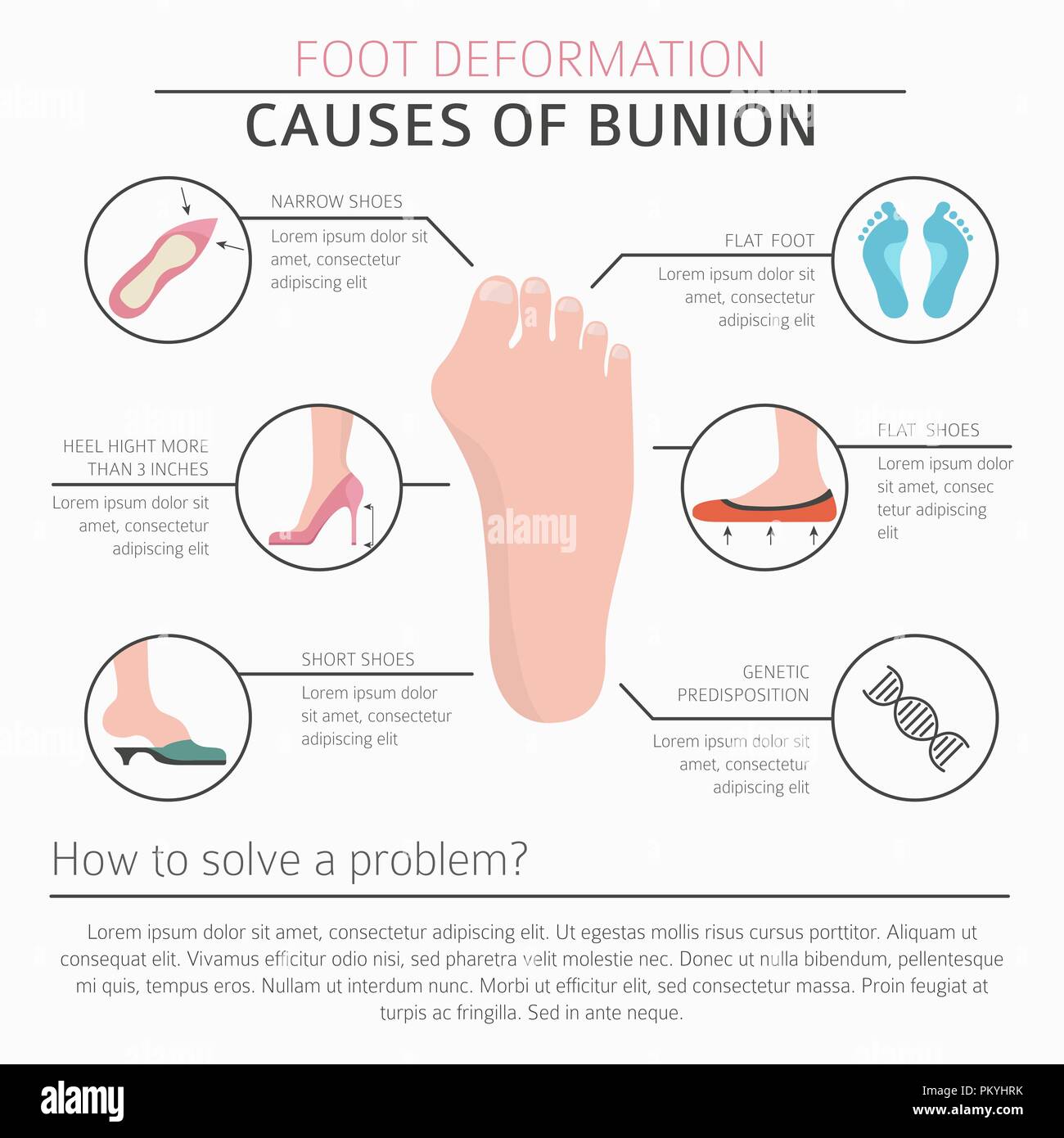 Foot deformation as medical desease infographic. Causes of bunion. Vector illustration Stock Vector