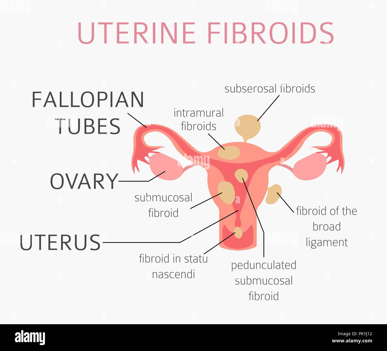 Uterine fibroids. Ginecological medical desease in women infographic ...