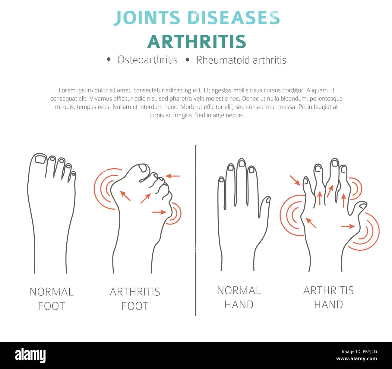 Joints diseases. Arthritis symptoms, treatment icon set. Medical ...