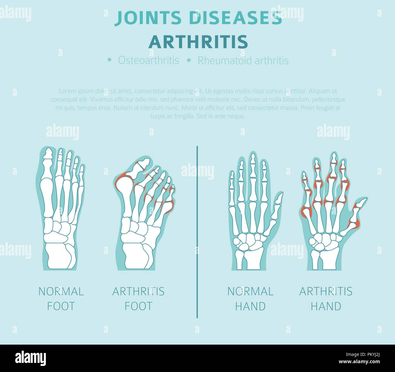 Joints diseases. Arthritis symptoms, treatment icon set. Medical
