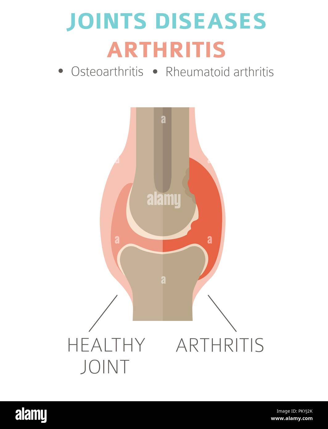 Joints diseases. Arthritis symptoms, treatment icon set. Medical