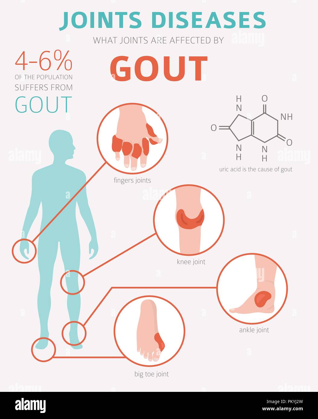Joints Diseases Gout Symptoms Treatment Icon Set Medical Infographic Design Vector Illustration Stock Vector Image Art Alamy
